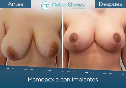 Ciruga de Senos Mamopexia con Implantes