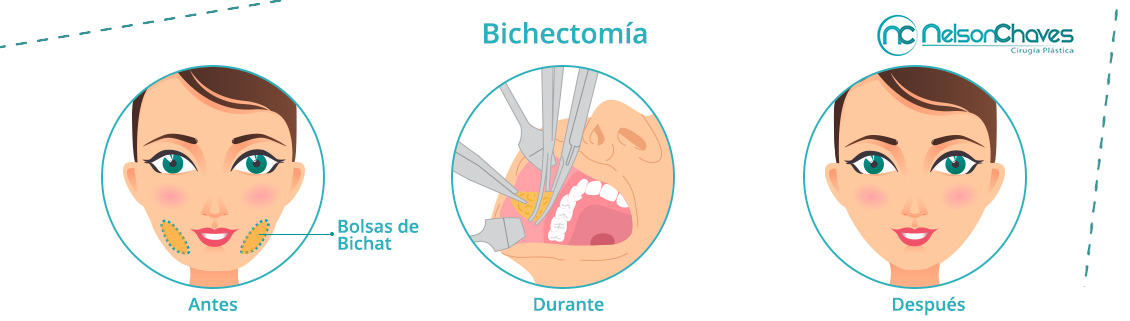 Bichectomía Procedimiento