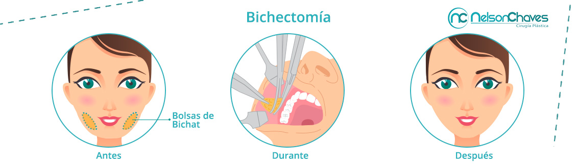 Bichectoma Procedimiento