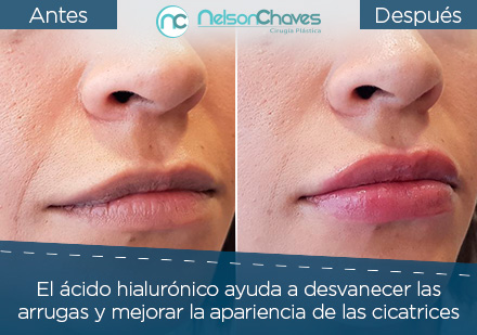 Rejuvenecimiento Facial con cido Hialurnico Paciente Satisfecha