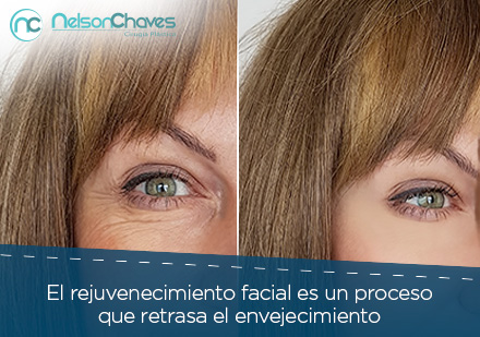 Rejuvenecimiento Facial Resultados