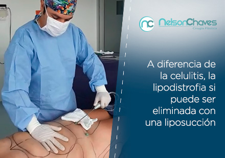 Liposuccin con Doctor Chaves a Paciente