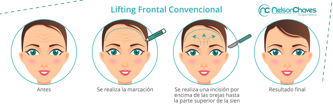 Pasos de una Frontoplastia o Lifting de Frente