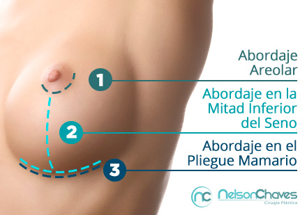 El Abordaje de Implante de Senos Depende de la Forma de los Senos, Volumen y Proyección Abordaje de Implante de Senos Ejemplo Pecho de Mujer Marcación de Posibles Cortes