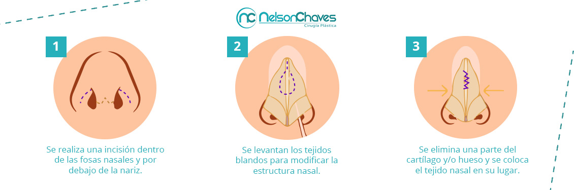 Conoce el Procedimiento de tu Cirugía de Nariz Pasos Cirugía de Nariz