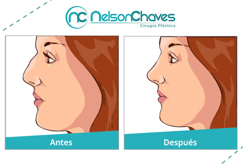 Mejora la Apariencia Estética con una Cirugía de Nariz Cirugía de Nariz