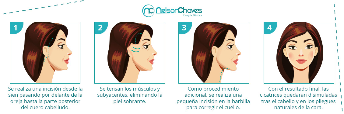 Signos Evidentes de la Edad son Mejorados con la Ritidoplastia Ritidoplastia facial o cervical