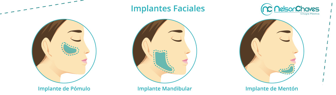 Implantes Faciales