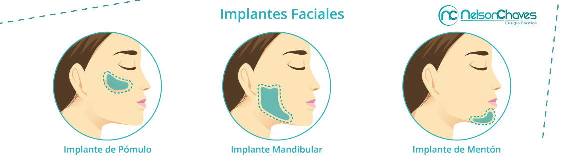 Aumenta tus Pómulos, Mentón y Ángulo Mandibular con Implantes Faciales Implantes Faciales