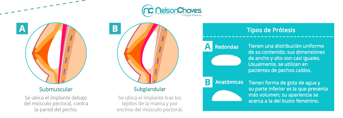 El Aumento de Senos es una Cirugía Plástica Ambulatoria. Aumento de Senos