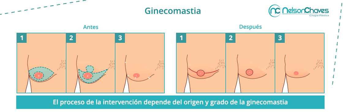 Reduccin de Senos en Hombres