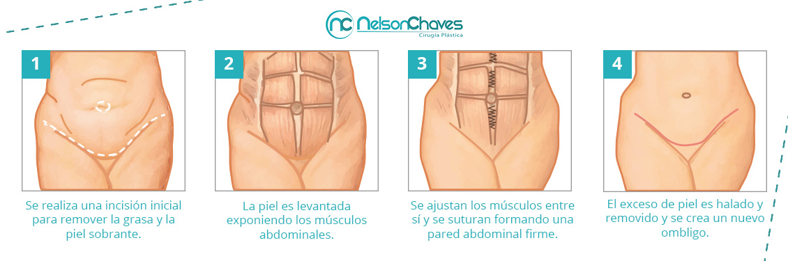 Lipectomia abdominal o abdominoplastia