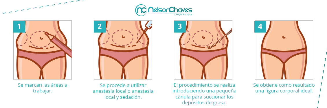 Consigue un Contorno Corporal Ideal con una Liposucción Liposucción Lipoescultura