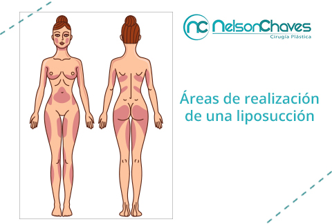 Estas Áreas Aplican para una Liposucción Áreas Liposucción Lipoescultura