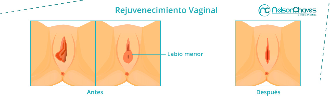 El Rejuvenecimiento Vaginal Mejora en Gran Medida tu Autoestima Rejuvenecimiento Vagianl