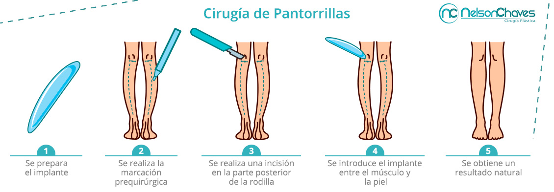 Obtén Piernas más Definidas y Estéticamente Armoniosas con una Cirugía de Pantorrillas Aumento de Pantorrillas