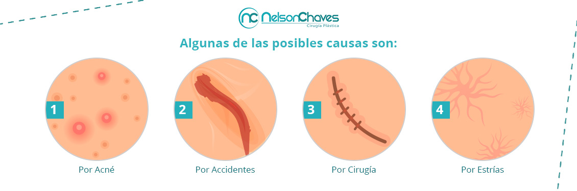 Conoce los Diferentes Tipos de Cicatrices Más Comunes Corrección de Cicatrices