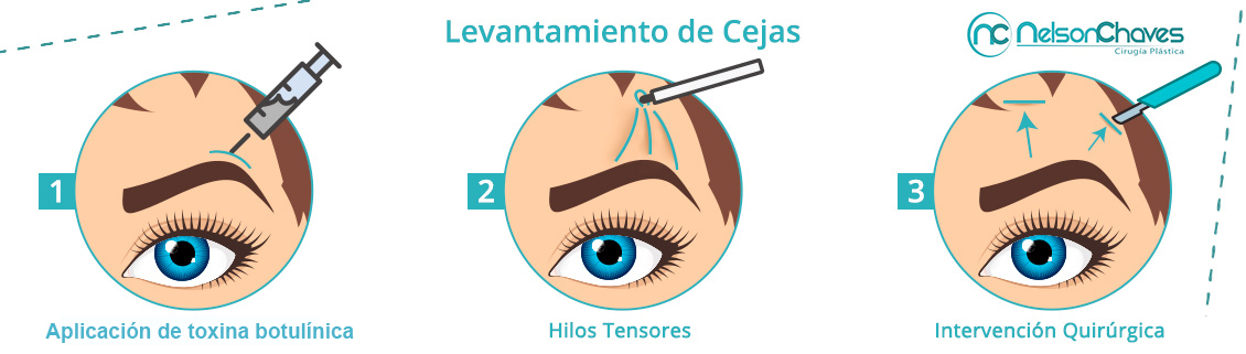 Levantamiento de Cejas