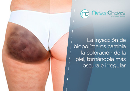 Piel Afectada por Inyeccin de Biopolmeros