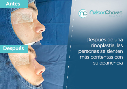 Antes y Despus de una Operacin por un Cirujano Plstico de Rinoplastia