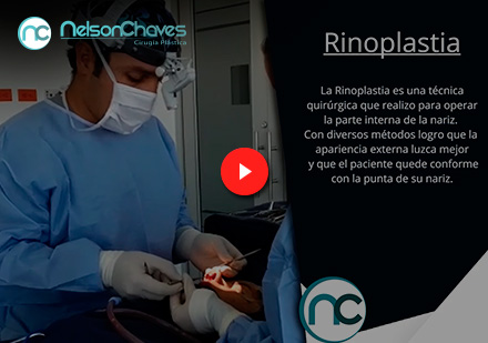  Video de una Intervención por un Cirujano Plástico de Rinoplastia
