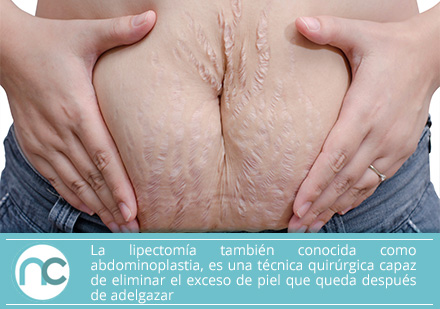 Obtén un abdomen firme con una lipectomía en manos de un experto cirujano plástico en Colombia