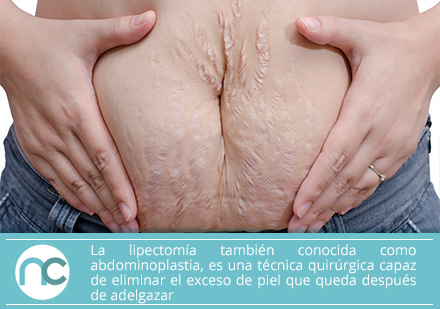 Obtén un abdomen firme con una lipectomía en manos de un experto cirujano plástico en Colombia Obtén un abdomen firme con una lipectomía en manos de un experto cirujano plástico en Colombia