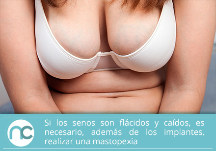 Elige el implante adecuado con el asesoramiento de un cirujano plástico de aumento de senos Una mujer con senos caídos debe realizarse una maxtopexia