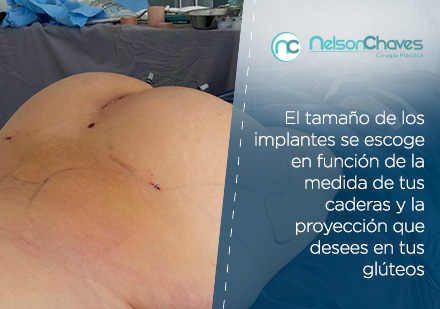 El Tamaño Siempre lo Decidirá el Cirujano Plástico en Colombia Gluteoplastia por un Cirujano Plástico en Colombia