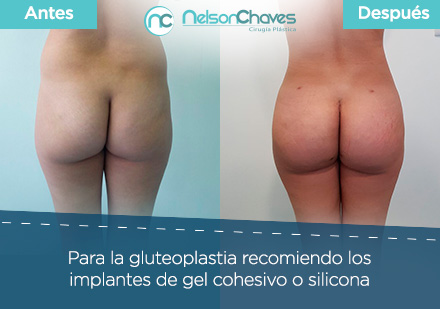 Dr. Chaves es un Cirujano Plástico en Colombia Especialista en el Aumento de Glúteos Antes y Después de una Gluteoplastia por un Cirujano Plástico en Colombia