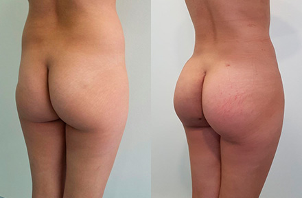 La Gluteoplastia Debe ser Asesorada por un Cirujano Plástico en Colombia Mujer Operada por un Cirujano Plástico en Colombia