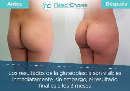 La Gluteoplastia Debe ser Asesorada por un Cirujano Plástico en Colombia Mujer Operada por un Cirujano Plástico en Colombia