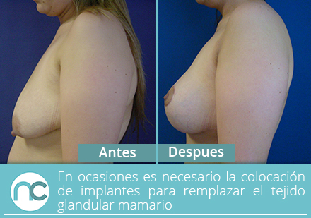 Un cirujano plástico en Colombia te ayuda reafirmar tu busto con un levantamiento de senos Mujer antes y después de una mamopexia