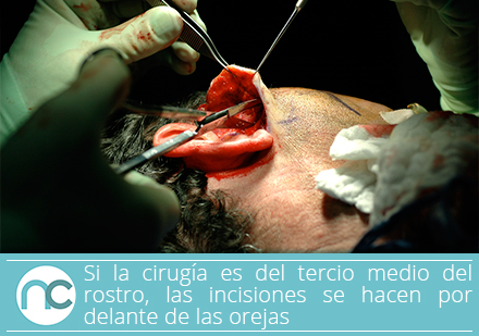 Cirujano plastico realiza una incisión delante de la oreja para rejuvenecimiento facial 