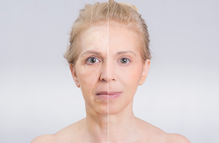 Cirujano plástico en Bogotá explica los beneficios de la Toxina Botulínica Mujer antes y después de aplicación de Toxina Botulínica por un cirujano plástico en bogotá