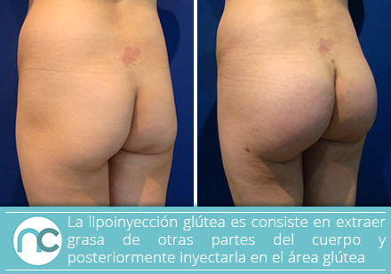 Un cirujano plástico en Colombia puede realizarte una lipoinyección glútea Antes y después de una lipoinyección glútea