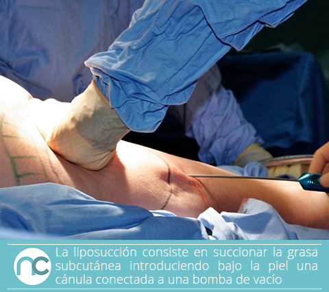 Cirujano plástico en Bogotá realizando una liposucción