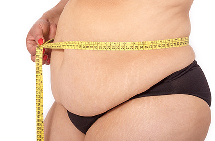 Mujer con exceso de grasa antes de una liposucción en Bogotá 