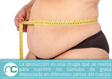 Mujer con exceso de grasa antes de una liposuccin en Bogot 