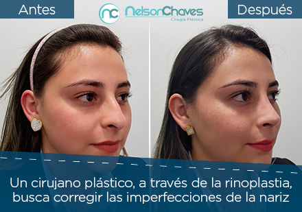 Cirujano Plstico de Rinoplastia Antes y Despus de un Paciente 