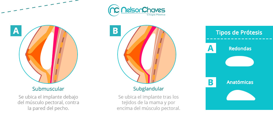 Tipos de Implantes para un Ciruga de Senos