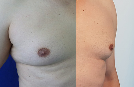 Antes y después de una reducción de senos en hombre