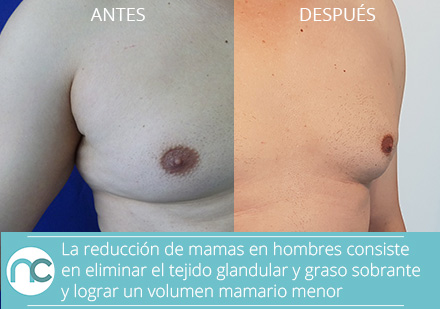Hombre antes y después de una cirugía de reducción de senos en colombia