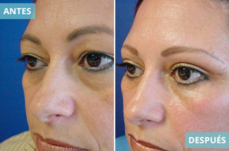 Blefaroplastia 8