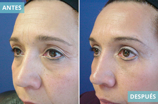 Blefaroplastia 9