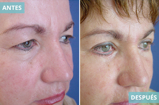 Blefaroplastia 10