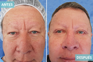 Blefaroplastia 13