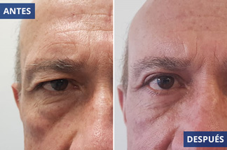 Blefaroplastia 4