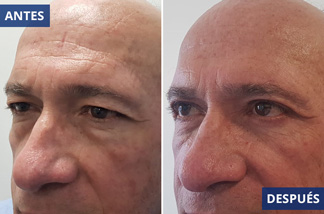 Blefaroplastia 5