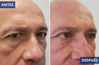 Blefaroplastia 6